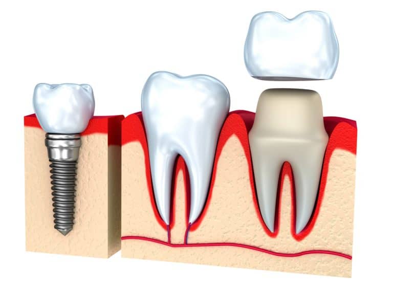 Dental Crowns Services Davie Florida